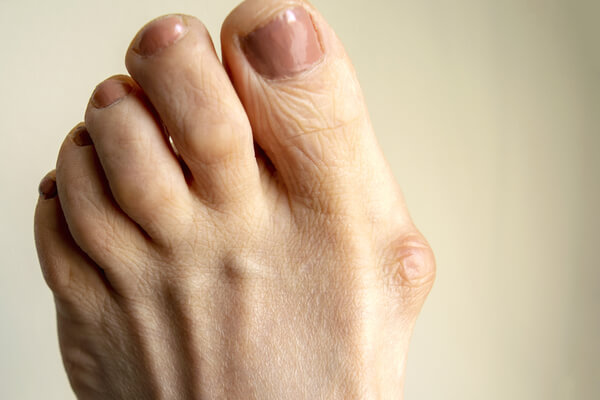 Subluxation and Bunions